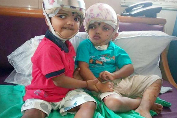 Surgery to separate 28-month-old Jagga and Kalia recorded in Limca Book Surgery to separate 28-month-old Jagga and Kalia recorded in Limca Book