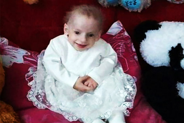 8-year-old girl died of disease called progeria 8-year-old girl died of disease called progeria