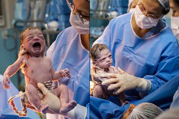 Newborn girl seen in anger while cutting umbilical cord, pictures viral Newborn girl seen in anger while cutting umbilical cord, pictures viral